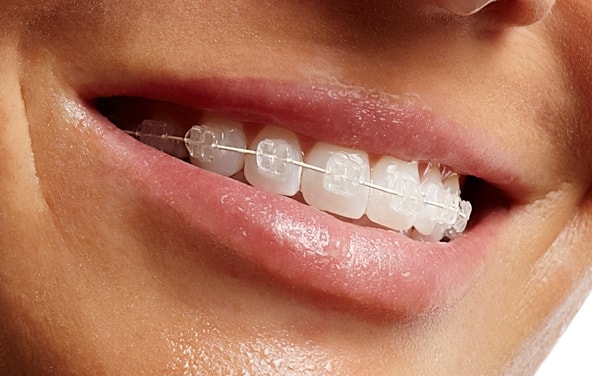 clear braces