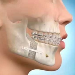 Jaw surgery