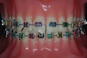 braces colours