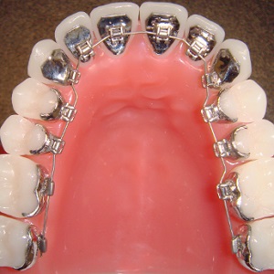 lingual braces