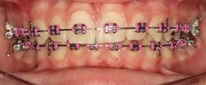 coloured braces