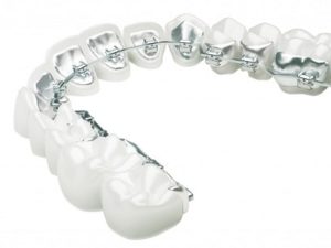 Lingual braces