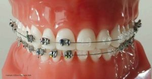 Clear and metal braces