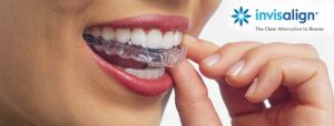 Invisalign treatment